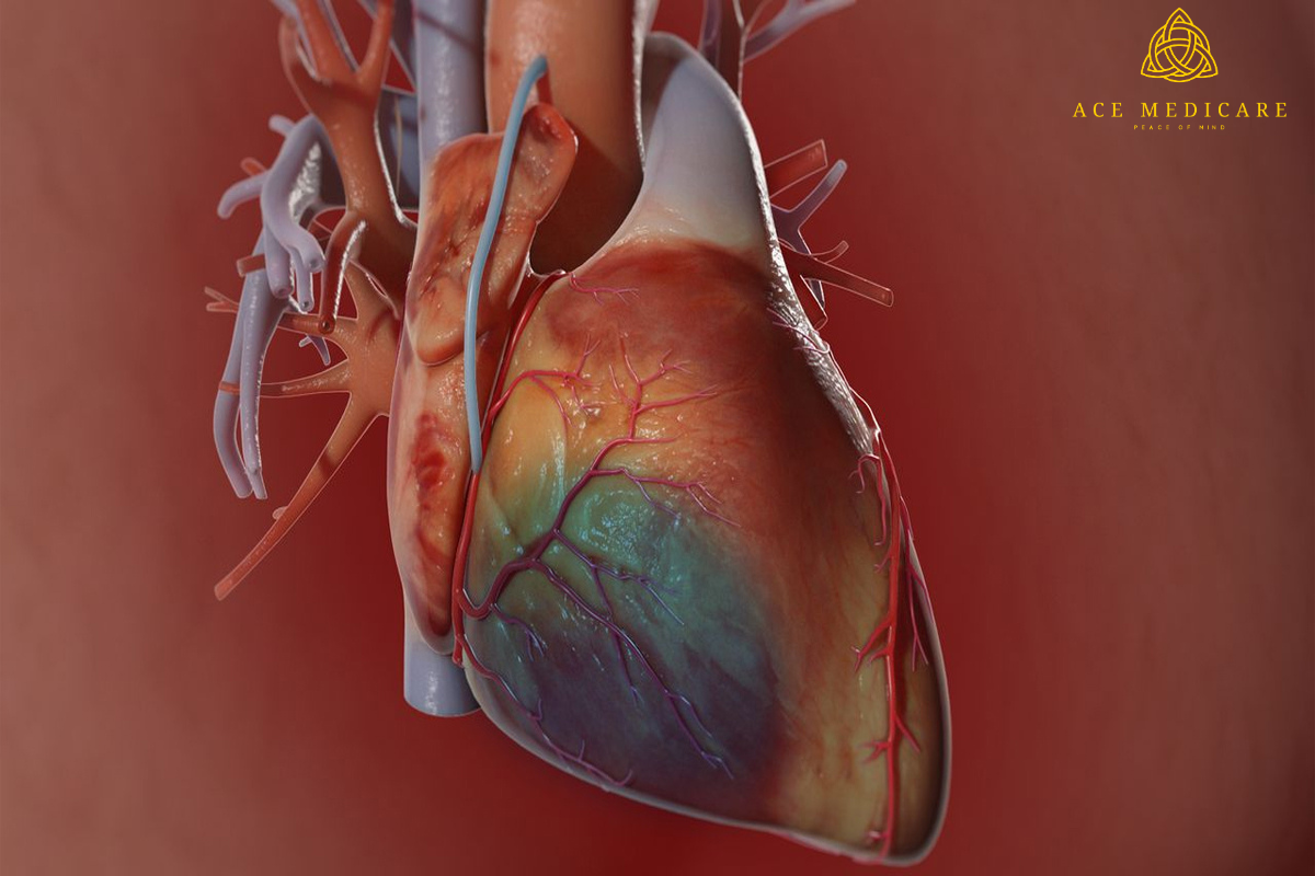 The Anatomy of a Coronary Bypass: Exploring the Surgical Procedure